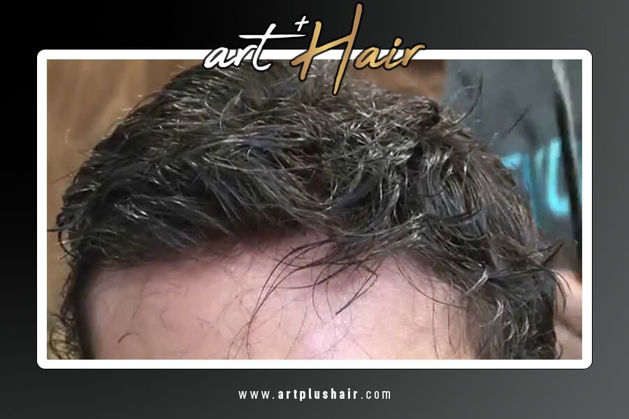 Protez Saç Fiyatları | Yüksek Kaliteli | Uygun Fiyat