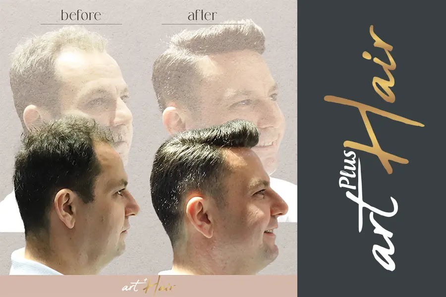 Aydın İli Protez Saç Uygulaması