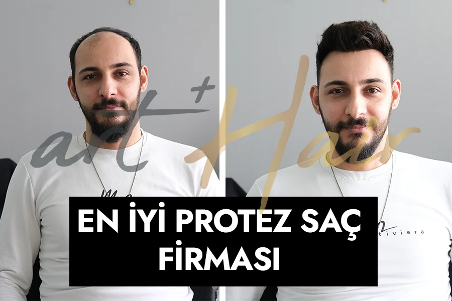 En İyi Protez Saç Firması - İstanbul