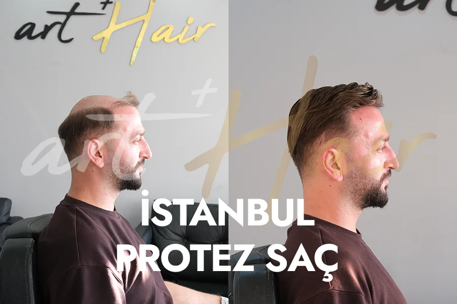 İstanbul Protez Saç Uygulaması